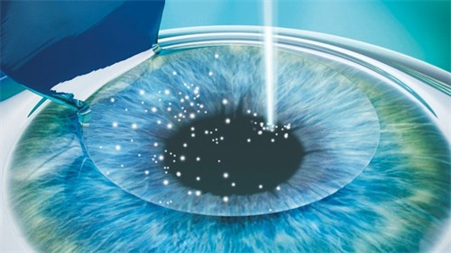探秘昆明润城普瑞眼科:飞秒成果/ICL技术多方位解析