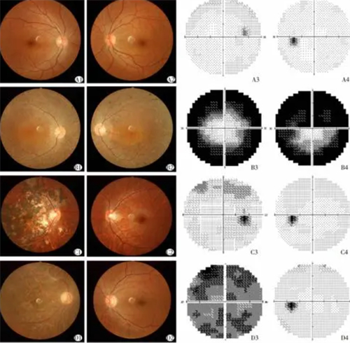 视网膜色素变性检查图