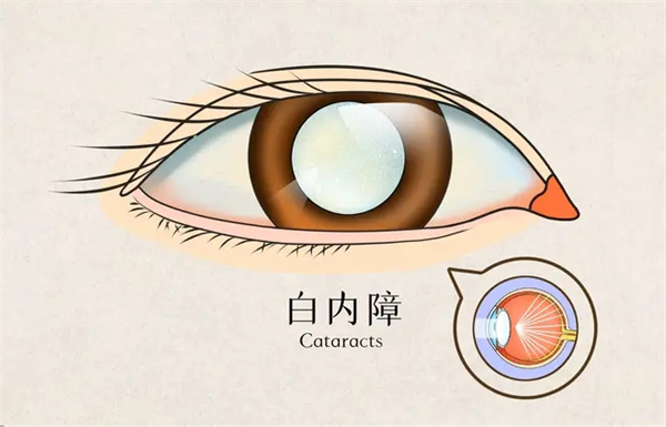 儋州白内障手术免费政策新消息，60岁以上老年人及残疾人符合条件的可申请免费手术！