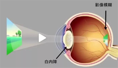 白内障成像