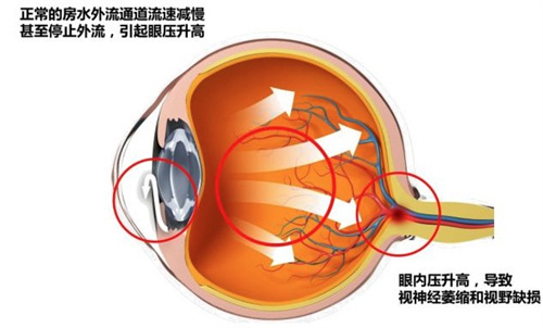 什么是急性闭角型青光眼