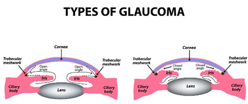 开角型和闭角型青光眼