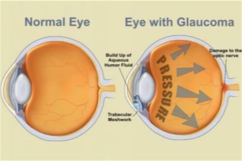 青光眼示意图