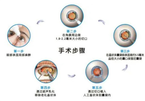 中卫如何申请免费白内障治疗？附中卫市免费白内障申请要求和流程！