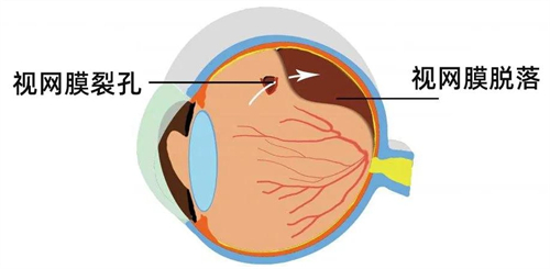 视网膜脱落多久会失明?要怎么治愈?视网膜脱落眼睛会变形吗?