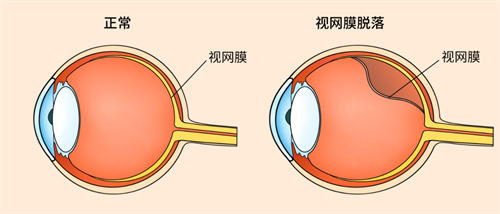 视网膜脱落跟正常眼睛