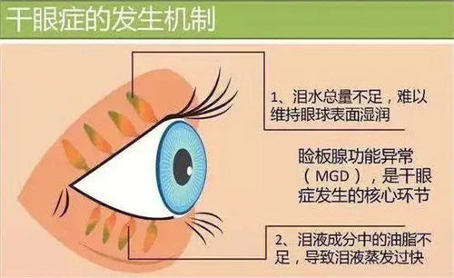 破解睑板腺堵塞干眼症谜题:激光治疗必要性/热敷功效及治愈可能性深度剖析