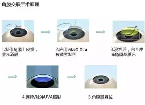 大连圆锥角膜手术价格表，附角膜交联/角膜环植入/角膜移植各类费用！