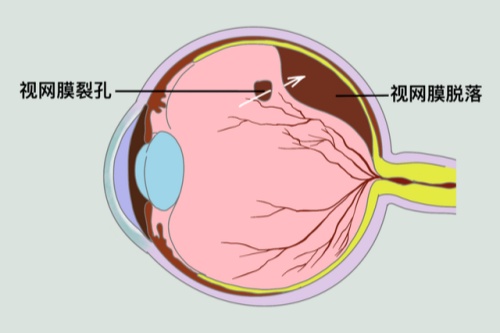 视网膜脱落卡通图