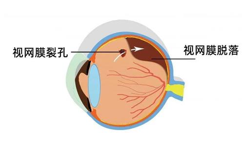 视网膜脱落的示意图