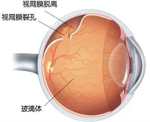 视网膜脱落现象展示