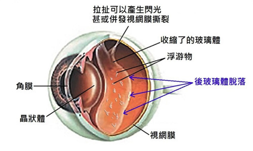 视网膜脱落的眼球