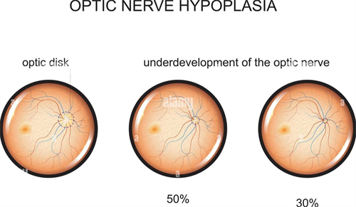 视神经萎缩不同程度表现形式