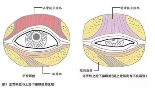 眼睑闭合不全的样子