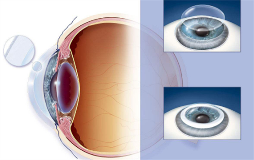 科普：人工眼角膜现在技术怎么样？成熟吗？人工眼角膜能用多少年？