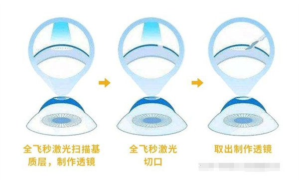 全飞秒激光治眼睛切口