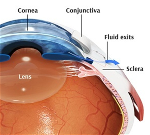 青光眼引流阀植入术大揭秘:成果咋样/能撑多久/术后问题多不多
