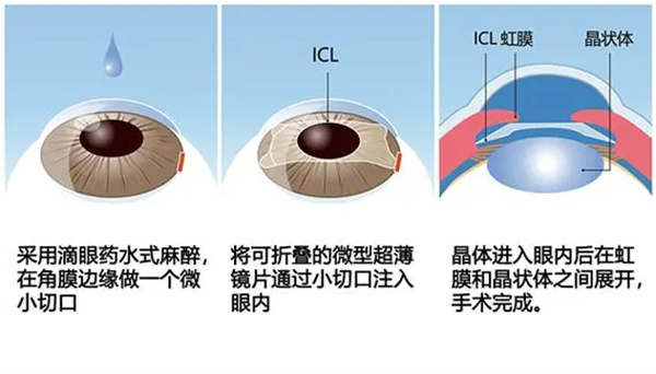 icl晶体植入手术方法