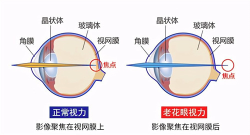 2025年老视手术价格表，普通医院老花眼6000元起！