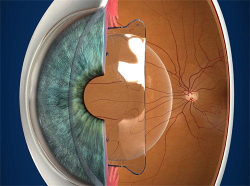 聚焦三焦点人工晶体手术:成熟与否揭秘,后发障有无探究,术后适应时长解读