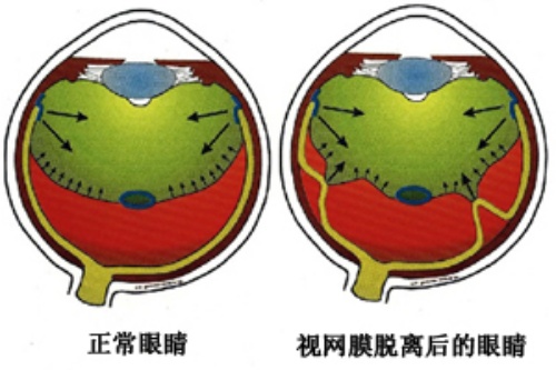 视网膜脱落卡通对比图