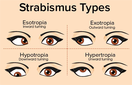 不同情况的眼睛斜视