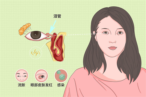 泪道阻塞常见的反应