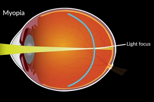 近视成像落在视网膜前