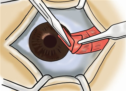翼状胬肉手术过程图解