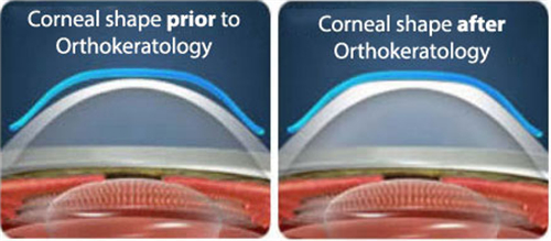 角膜塑形镜眼表前后对比