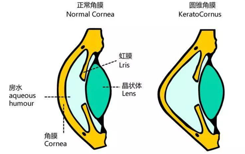 一文读懂角膜交联术:术后视力何时提升?需住院吗?注意事项有哪些?