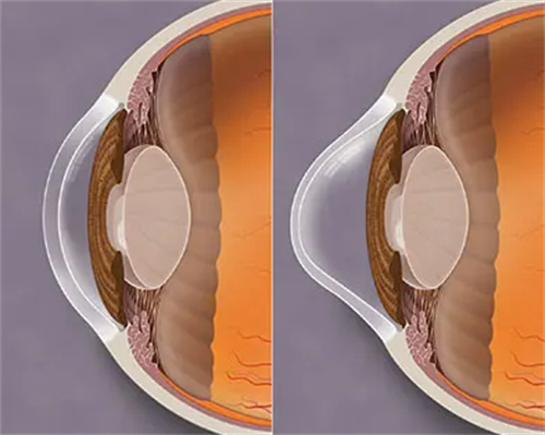 正常角膜和圆锥角膜的区别对比