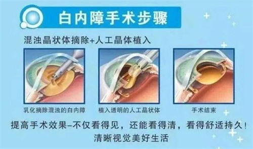 仙桃做白内障有免费做的吗？有 定点医院免费名额是公开可以申请的！