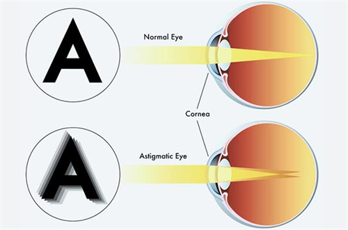 正常眼睛和弱视眼睛成像不同