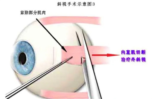 杭州斜视手术价格表查询，含各种手术类型/多家医院的斜视手术费用！