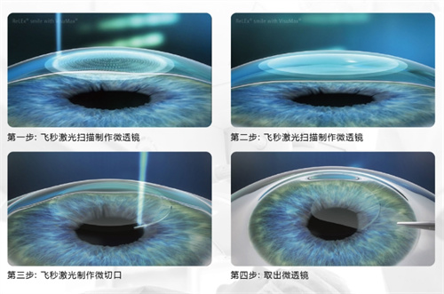 华中科技大学协和深圳医院眼科价格表查询，近视手术8800元起/白内障4000元起/青光眼3500元起！