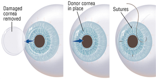 角膜移植必知:是人工角膜吗?视力能重回多少?变差咋补救?