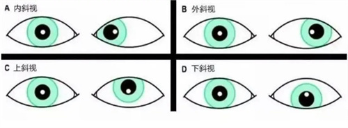 银川做斜视矫正多少钱？附上2025银川斜视手术价格表！