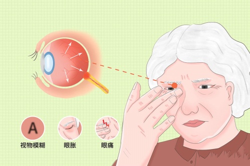 视神经萎缩卡通图