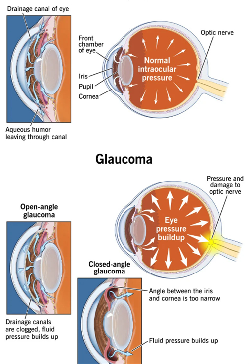青光眼和正常眼睛眼压不同