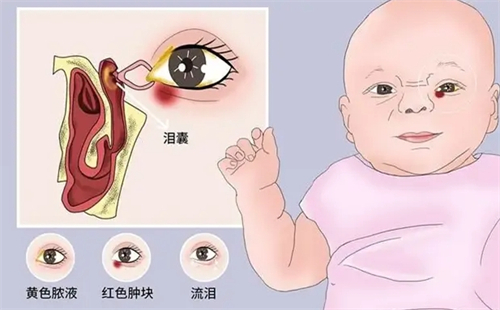 泪道堵塞手术后多久能正常工作?会复发吗?术后用眼禁忌与复发预警信号