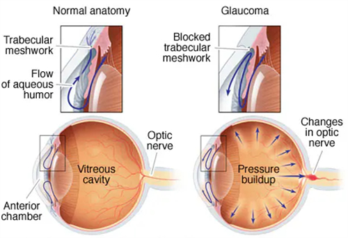 青光眼和正常眼镜眼压区别