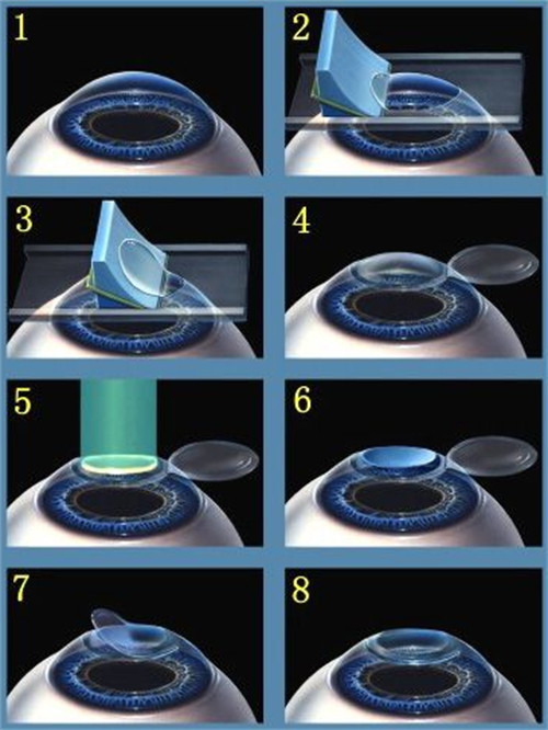 近视手术的手术过程