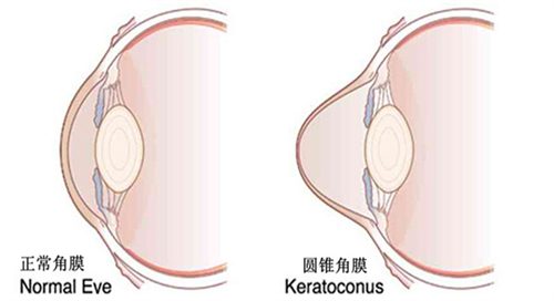 圆锥角膜交联手术大揭秘：做了能好吗?控制发展能持续几年?