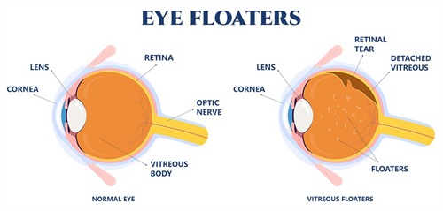 正常眼睛和飞蚊症眼睛的区别