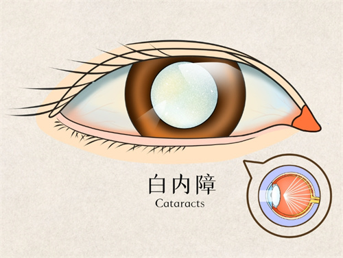 诸暨人民医院眼科收费标准公布，含近视/白内障/斜视/青光眼等价格！