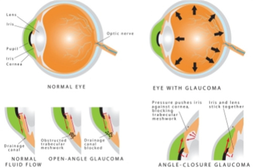 青光眼手术大概需要多少钱，基础青光眼手术/复杂青光眼手术收费价格表揭晓！