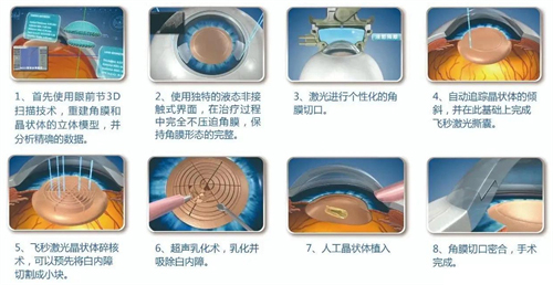 超声乳化白内障手术细节 超声乳化白内障手术细节