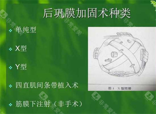 后巩膜加固术种类