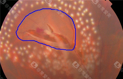 视网膜脱落细节图片
